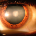 cataracte site information
